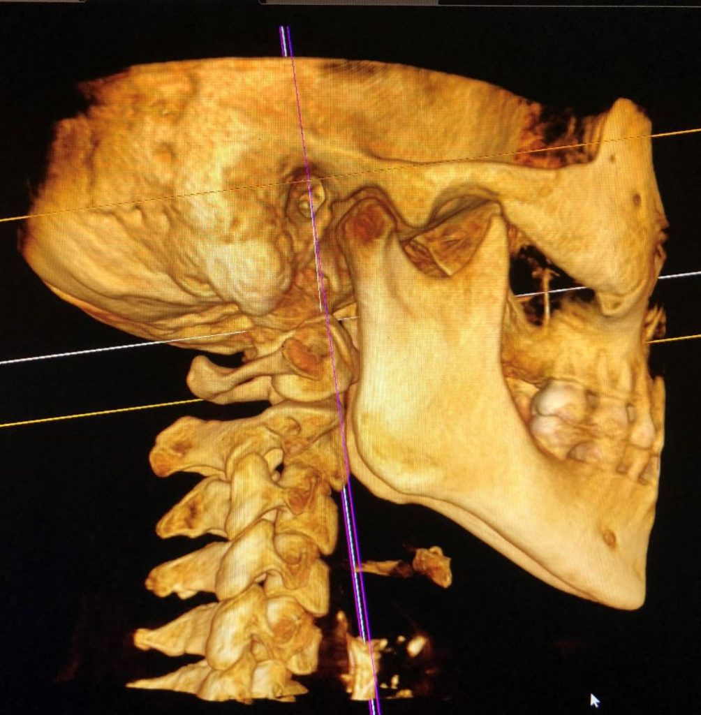 CBCT Scan